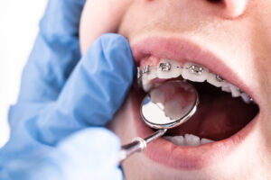 Close up of dentist examining teeth of child with braces